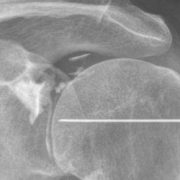 arthrographie et infiltration