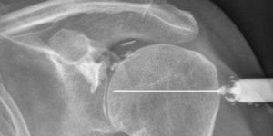 arthrographie et infiltration