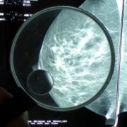 mammographie
