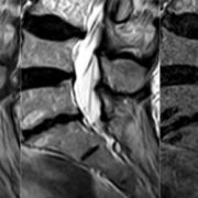 radiculographie lucchérini infiltration