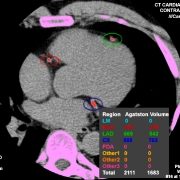 scanner cardiaque