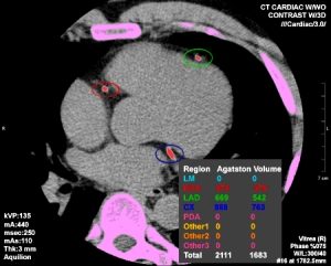 scanner cardiaque